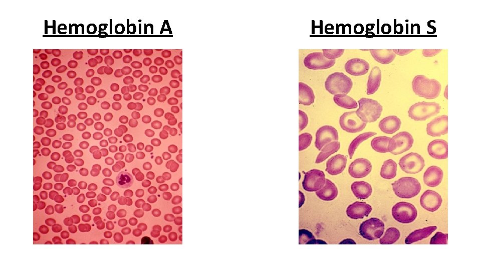 Hemoglobin A Hemoglobin S 
