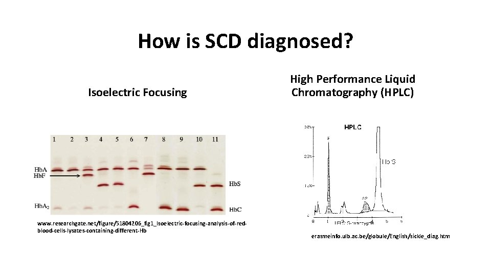 How is SCD diagnosed? Isoelectric Focusing www. researchgate. net/figure/51804206_fig 1_Isoelectric-focusing-analysis-of-redblood-cells-lysates-containing-different-Hb High Performance Liquid Chromatography