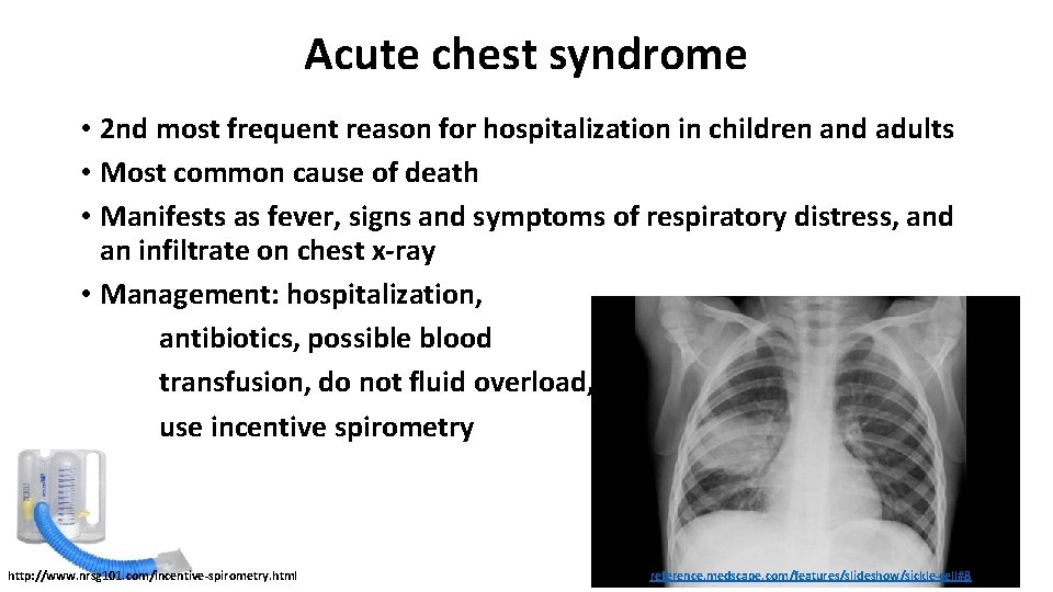 Acute chest syndrome • 2 nd most frequent reason for hospitalization in children and