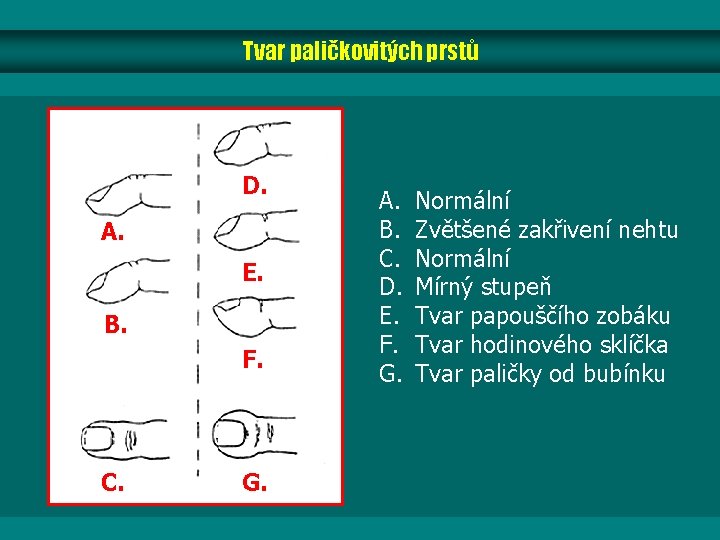 Tvar paličkovitých prstů D. A. E. B. F. C. G. A. B. C. D. Tvar paličkovitých prstů D. A. E. B. F. C. G. A. B. C. D.