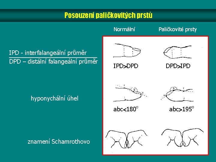 Posouzení paličkovitých prstů IPD - interfalangeální průměr DPD – distální falangeální průměr Normální Paličkovité Posouzení paličkovitých prstů IPD - interfalangeální průměr DPD – distální falangeální průměr Normální Paličkovité