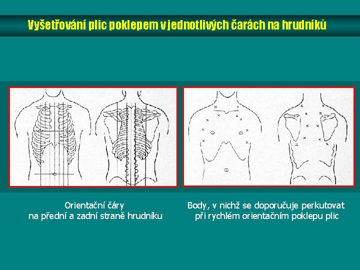 Vyšetřování plic poklepem v jednotlivých čarách na hrudníků Orientační čáry na přední a zadní Vyšetřování plic poklepem v jednotlivých čarách na hrudníků Orientační čáry na přední a zadní