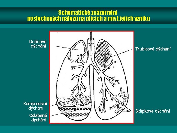 Schematické znázornění poslechových nálezů na plicích a míst jejich vzniku Dutinové dýchání Kompresivní dýchání Schematické znázornění poslechových nálezů na plicích a míst jejich vzniku Dutinové dýchání Kompresivní dýchání