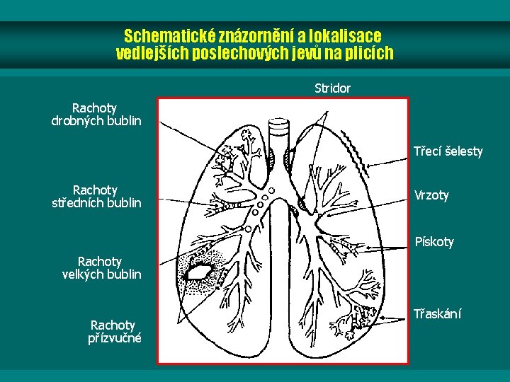 Schematické znázornění a lokalisace vedlejších poslechových jevů na plicích Stridor Rachoty drobných bublin Třecí Schematické znázornění a lokalisace vedlejších poslechových jevů na plicích Stridor Rachoty drobných bublin Třecí