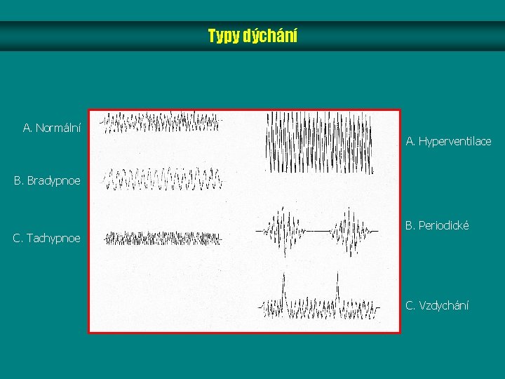 Typy dýchání A. Normální A. Hyperventilace B. Bradypnoe C. Tachypnoe B. Periodické C. Vzdychání Typy dýchání A. Normální A. Hyperventilace B. Bradypnoe C. Tachypnoe B. Periodické C. Vzdychání
