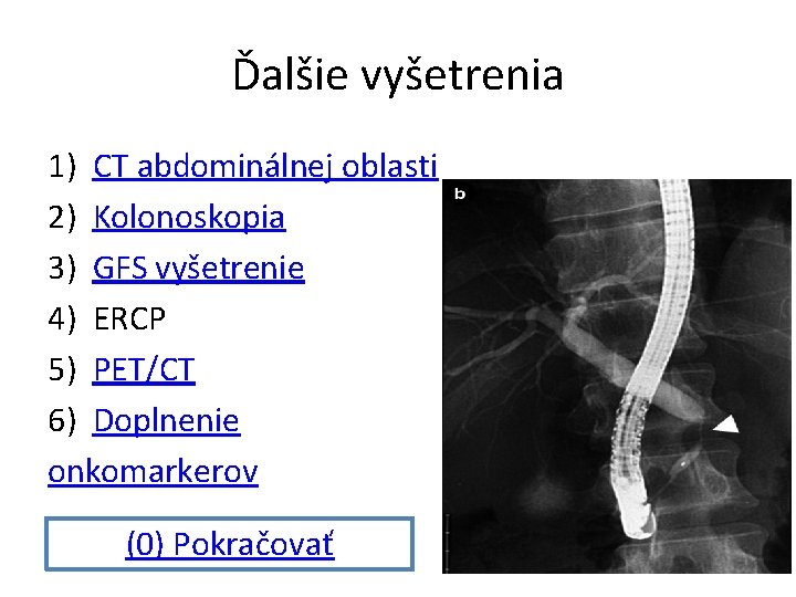 Ďalšie vyšetrenia 1) CT abdominálnej oblasti 2) Kolonoskopia 3) GFS vyšetrenie 4) ERCP 5)