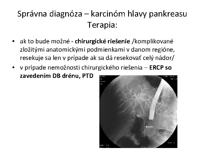 Správna diagnóza – karcinóm hlavy pankreasu Terapia: • ak to bude možné - chirurgické Správna diagnóza – karcinóm hlavy pankreasu Terapia: • ak to bude možné - chirurgické