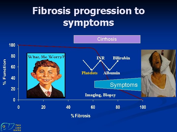 Fibrosis progression to symptoms Cirrhosis INR Platelets Bilirubin Albumin Symptoms Imaging, Biopsy TWH LIVER