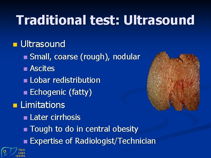 Traditional test: Ultrasound n Ultrasound Small, coarse (rough), nodular n Ascites n Lobar redistribution