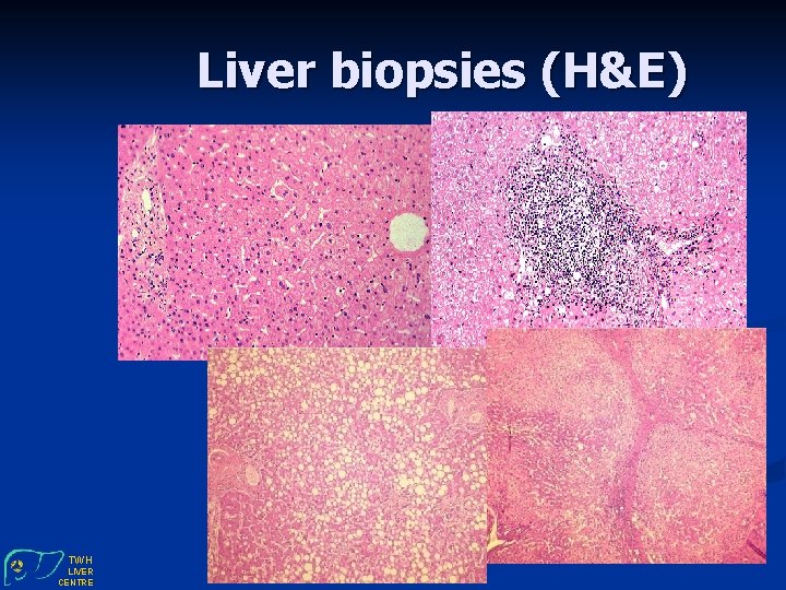 Liver biopsies (H&E) TWH LIVER CENTRE 