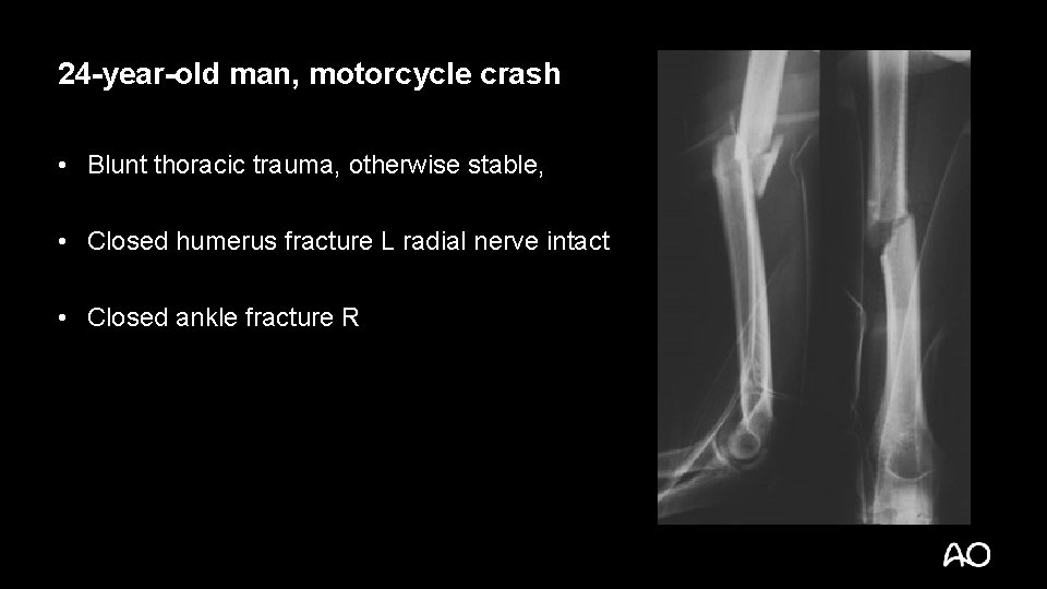 24 -year-old man, motorcycle crash • Blunt thoracic trauma, otherwise stable, • Closed humerus