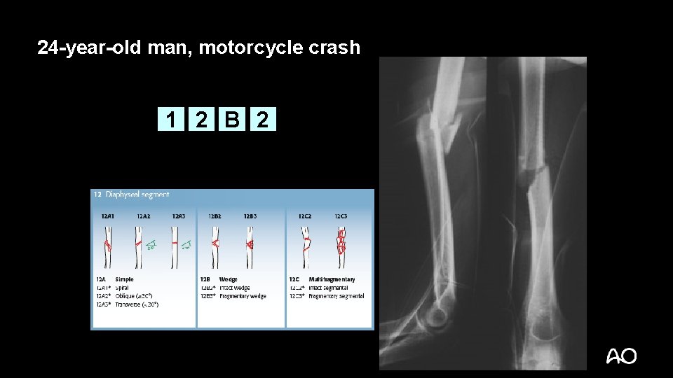 24 -year-old man, motorcycle crash 1 2 B 2 