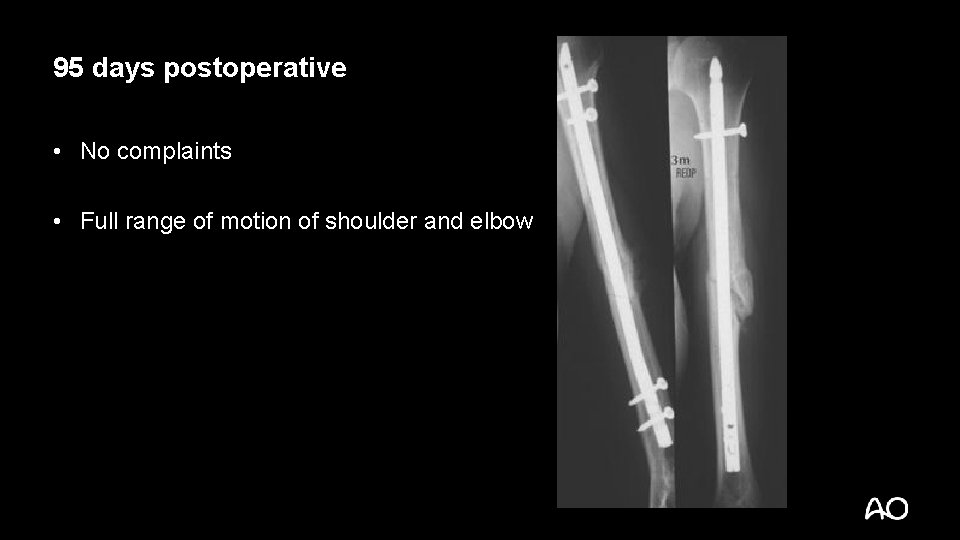 95 days postoperative • No complaints • Full range of motion of shoulder and