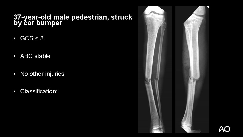 37 -year-old male pedestrian, struck by car bumper • GCS < 8 • ABC