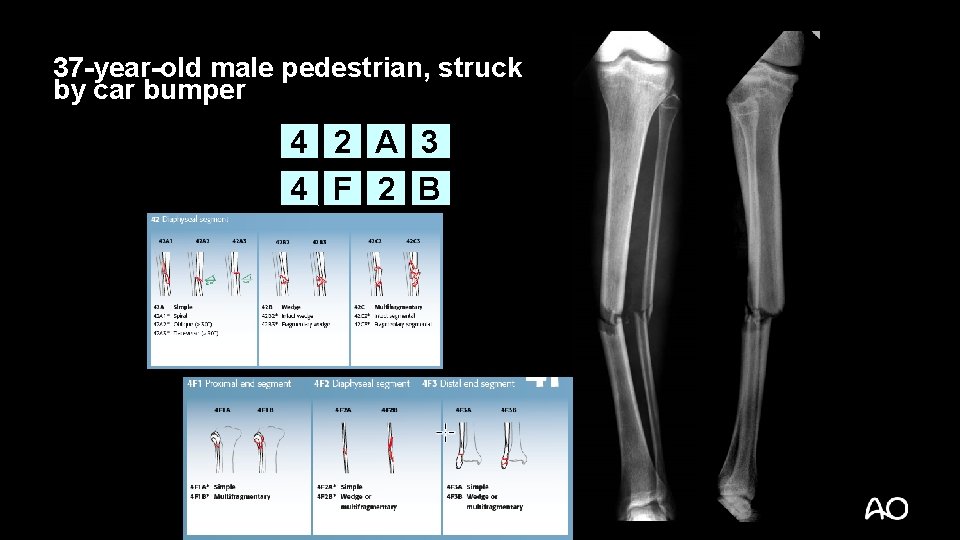 37 -year-old male pedestrian, struck by car bumper 4 2 A 3 4 F