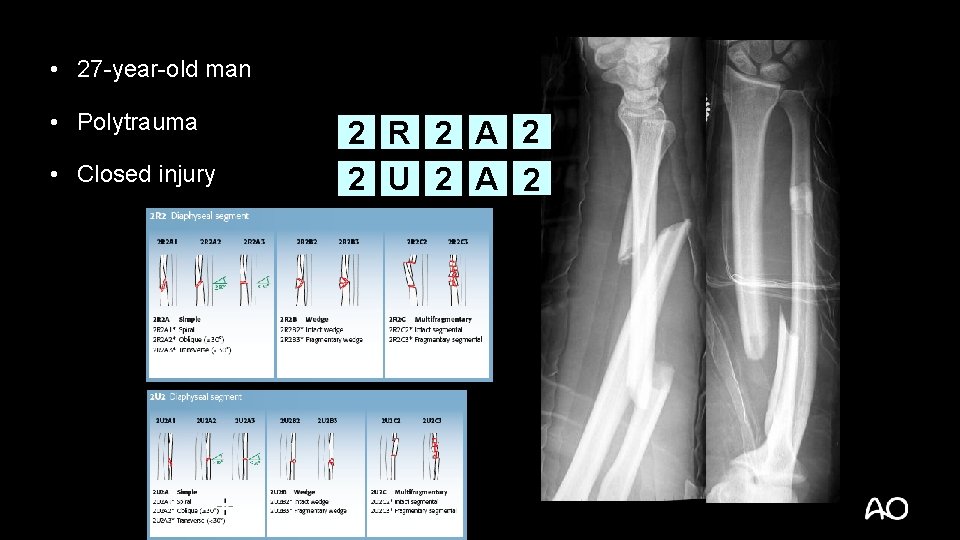  • 27 -year-old man • Polytrauma • Closed injury 2 R 2 A