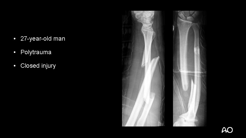  • 27 -year-old man • Polytrauma • Closed injury 