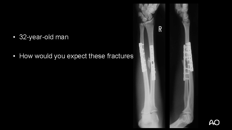  • 32 -year-old man • How would you expect these fractures to heal?