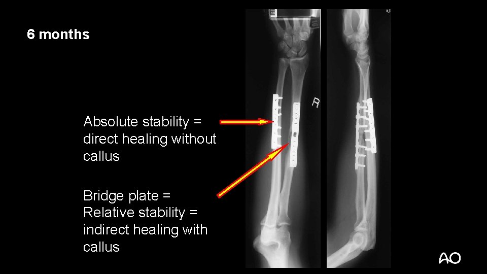 6 months Absolute stability = direct healing without callus Bridge plate = Relative stability