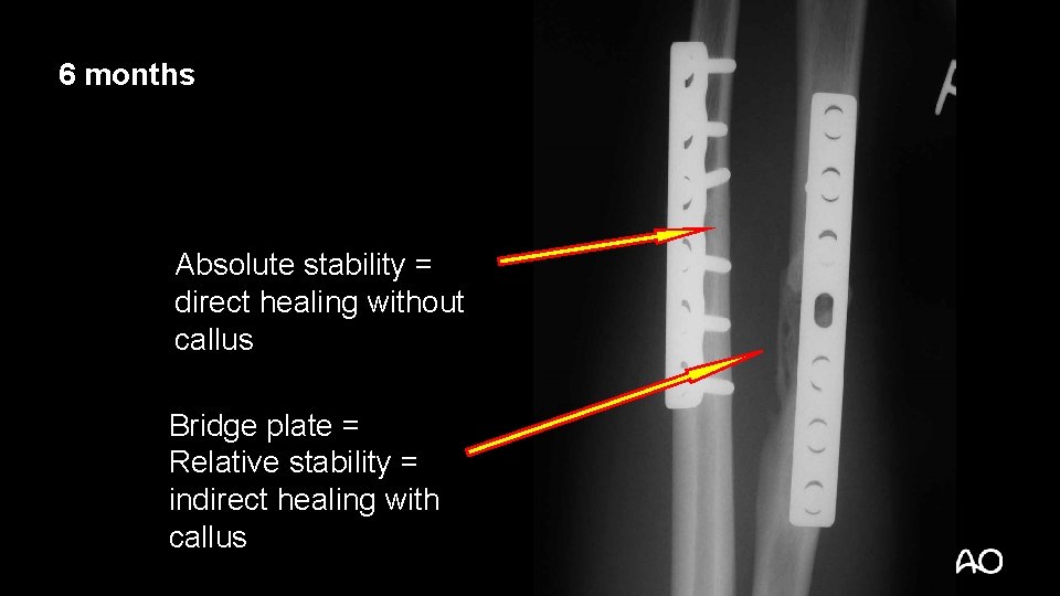 6 months Absolute stability = direct healing without callus Bridge plate = Relative stability