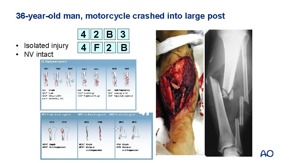 36 -year-old man, motorcycle crashed into large post • Isolated injury • NV intact