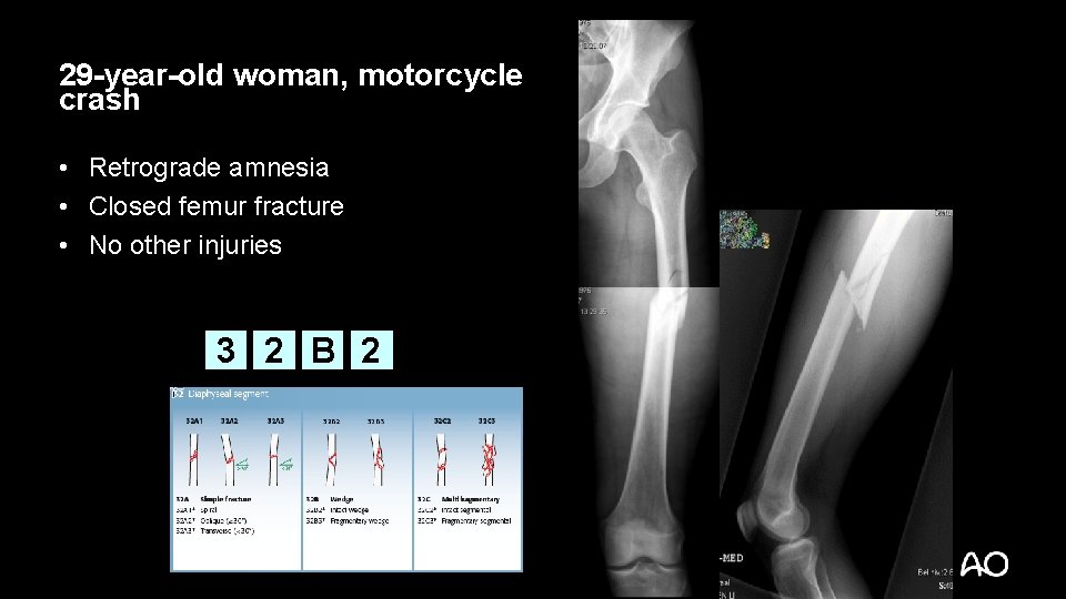 29 -year-old woman, motorcycle crash • Retrograde amnesia • Closed femur fracture • No