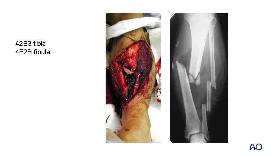 42 B 3 tibia 4 F 2 B fibula 