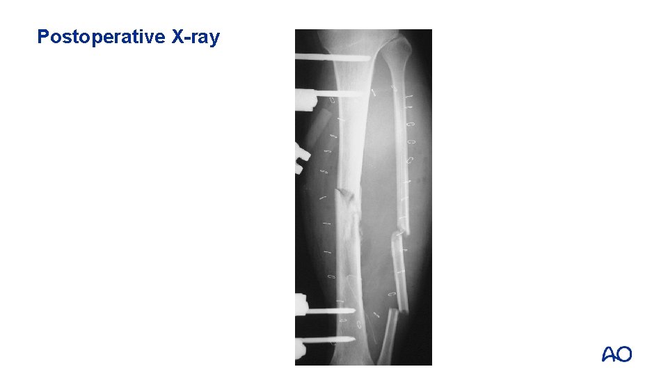 Postoperative X-ray 