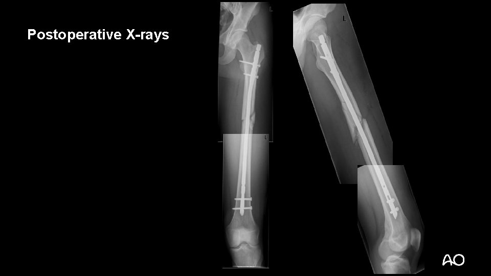 Postoperative X-rays 