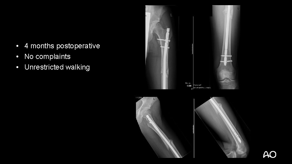  • 4 months postoperative • No complaints • Unrestricted walking 