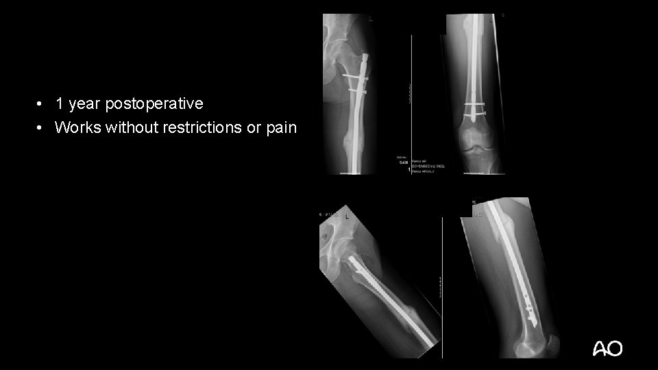  • 1 year postoperative • Works without restrictions or pain 