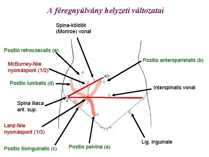 A féregnyúlvány helyzeti változatai Spina-köldök (Monroe) vonal Positio retrocoecalis (e) Positio anteroparietalis (b) Mc.