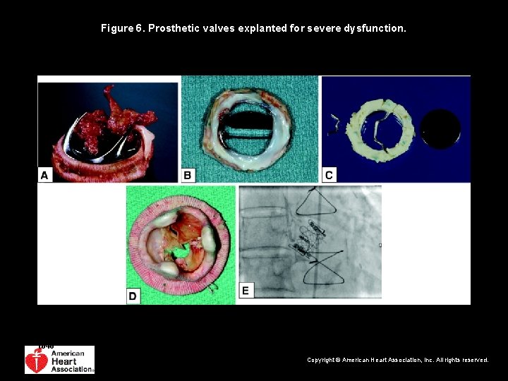 Figure 6. Prosthetic valves explanted for severe dysfunction. Pibarot P , and Dumesnil J