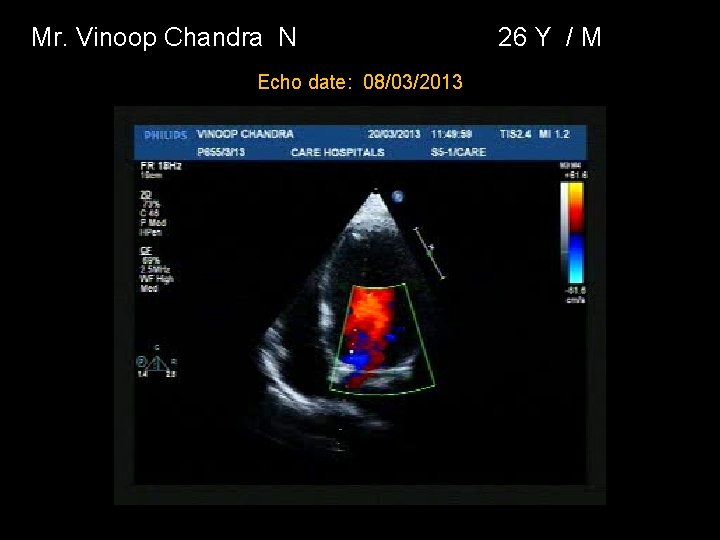 Mr. Vinoop Chandra N Echo date: 08/03/2013 26 Y / M 