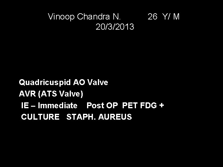 Vinoop Chandra N. 20/3/2013 26 Y/ M Quadricuspid AO Valve AVR (ATS Valve) IE