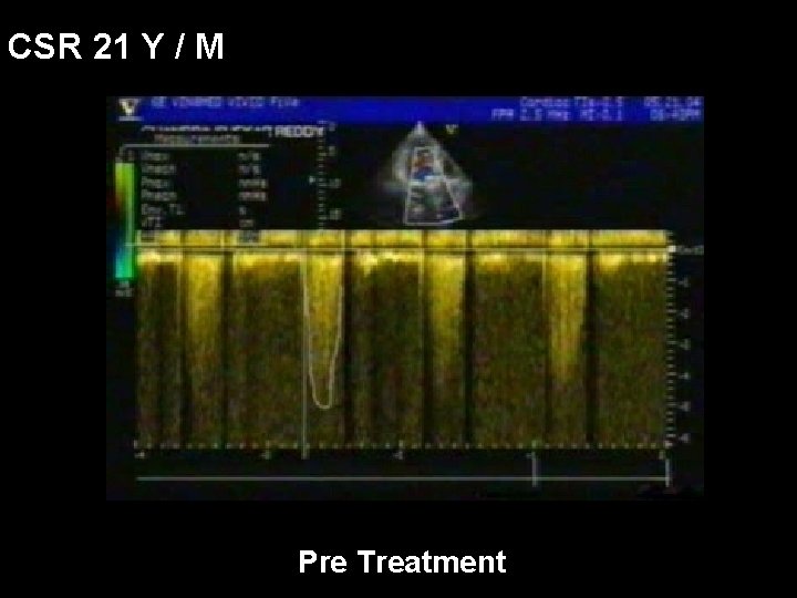 CSR 21 Y / M Pre Treatment 