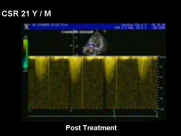 CSR 21 Y / M Post Treatment 