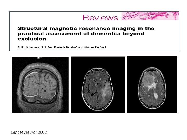 Lancet Neurol 2002 