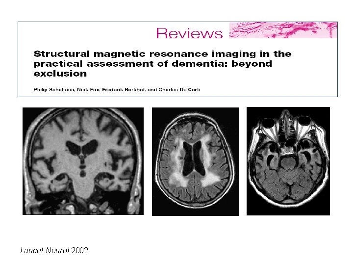 Lancet Neur 2002 Lancet Neurol 2002 