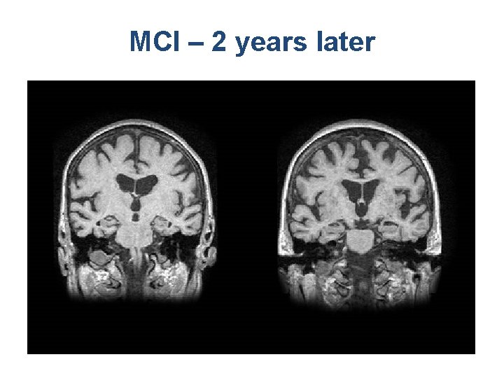 MCI – 2 years later 