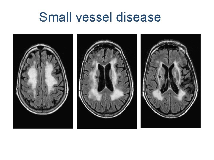 Small vessel disease 