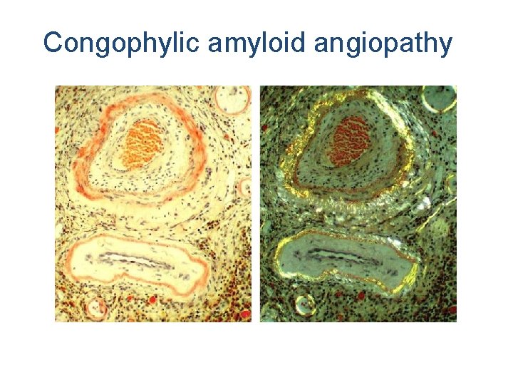 Congophylic amyloid angiopathy 