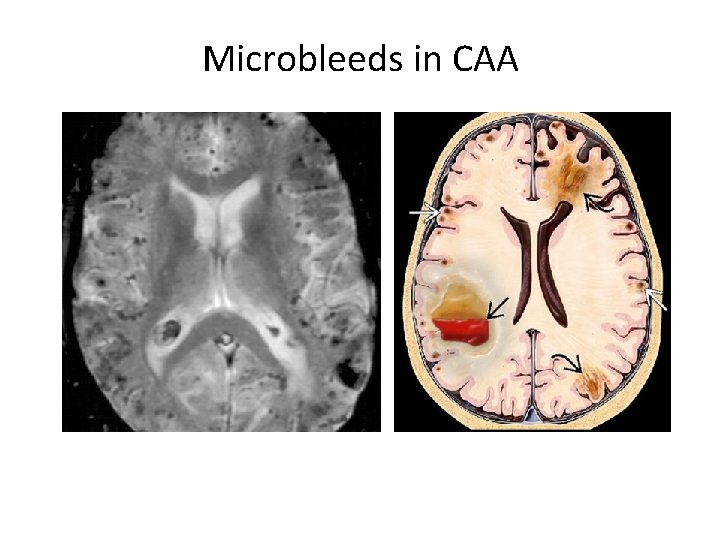 Microbleeds in CAA 