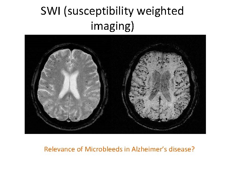 SWI (susceptibility weighted imaging) Relevance of Microbleeds in Alzheimer’s disease? 