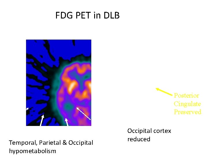 FDG PET in DLB Posterior Cingulate Preserved Temporal, Parietal & Occipital hypometabolism Occipital cortex