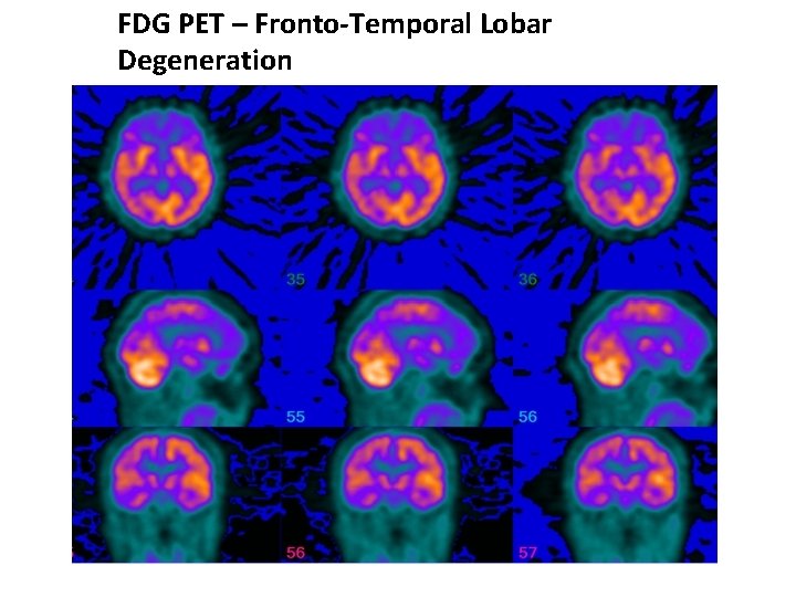 FDG PET – Fronto-Temporal Lobar Degeneration 