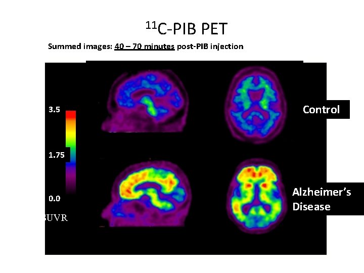 11 C-PIB PET Summed images: 40 – 70 minutes post-PIB injection 3. 5 Control