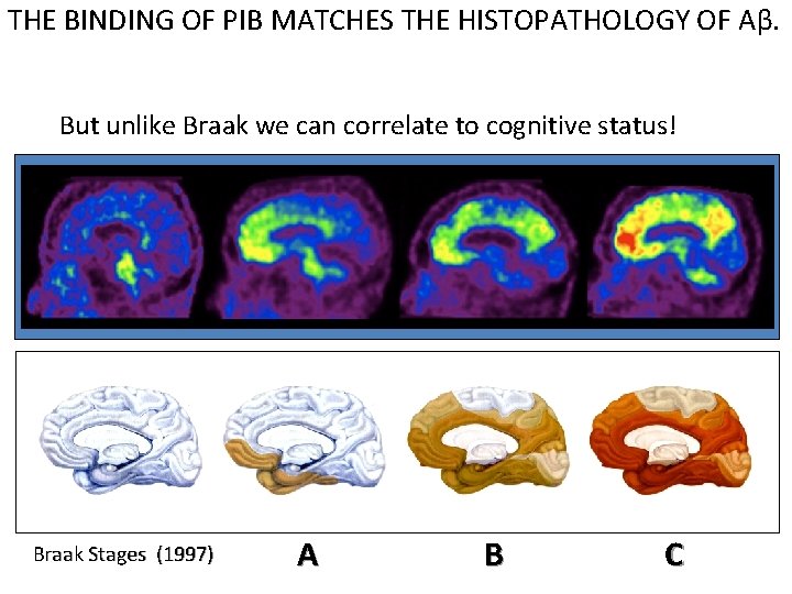 THE BINDING OF PIB MATCHES THE HISTOPATHOLOGY OF Aβ. But unlike Braak we can