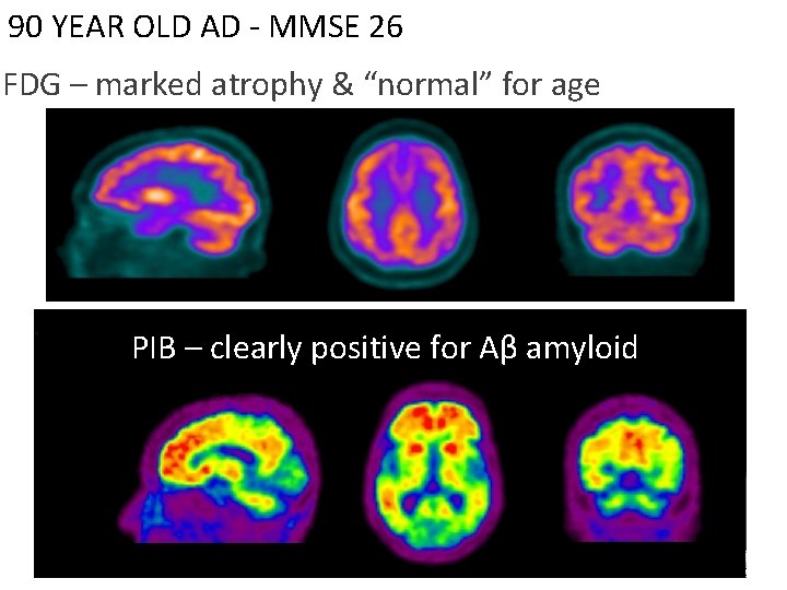 90 YEAR OLD AD - MMSE 26 FDG – marked atrophy & “normal” for