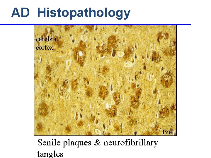 AD Histopathology cerebral cortex Biel Senile plaques & neurofibrillary tangles 